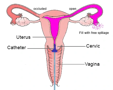 Diagram of a hysterosalpingogram: a catheter passed through the vagina and cervix into the uterus, with one fallopian tube occluded and the other open and spilling freely.