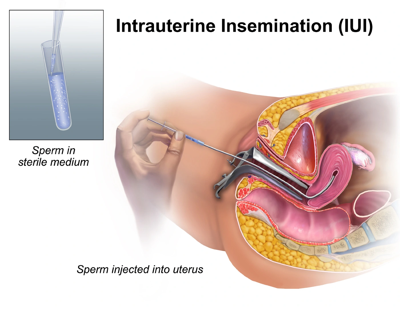 Diagram of intrauterine insemination: sperm in a sterile medium, then injected into the uterus.