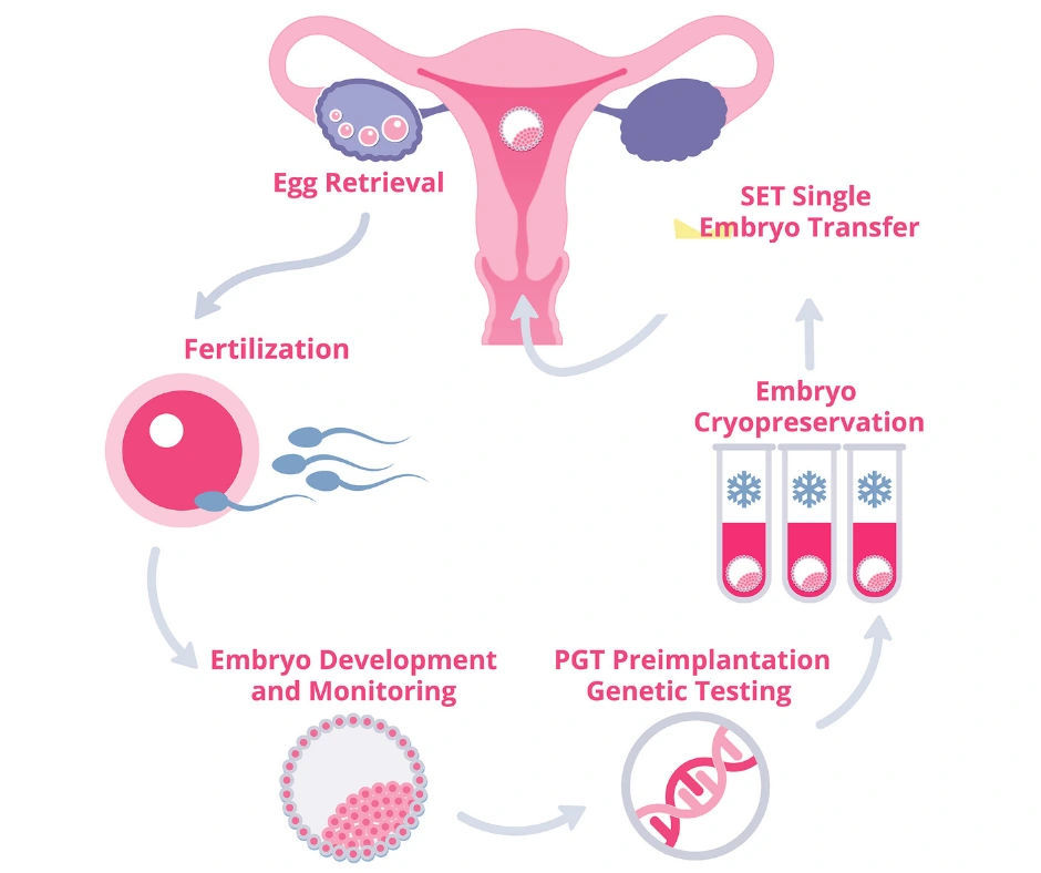 Diagram of the IVF cycle: egg retrieval, fertilisation, embryo development and monitoring, preimplantation genetic testing, cryopreservation, and single embryo transfer.