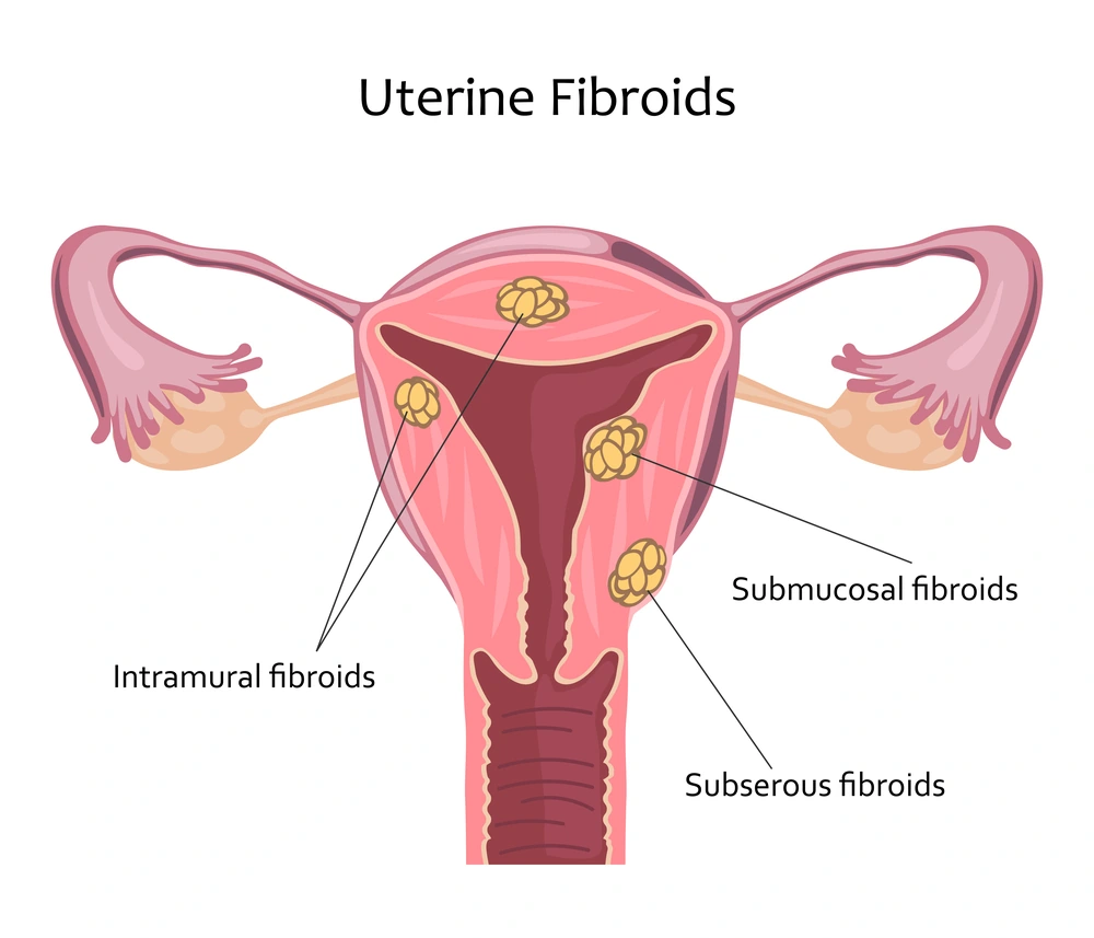 Diagram of a uterus showing where intramural, submucosal and subserous fibroids sit.